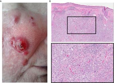 Case Report: Combined Intra-Lesional IL-2 and Topical Imiquimod Safely and Effectively Clears Multi-Focal, High Grade Cutaneous Squamous Cell Cancer in a Combined Liver and Kidney Transplant Patient